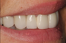 Closeup of Lisa's smile from left after