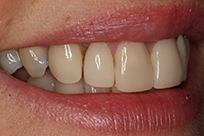 Closeup of Lisa's smile from left before