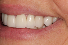 Closeup of Lisa's smile from right after