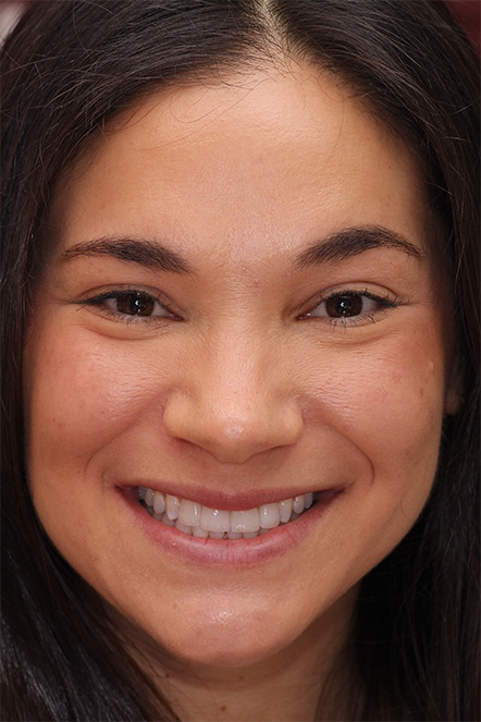 Dental patient with gap closed with veneers