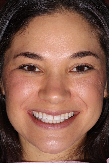 Dental patient with gap between front teeth
