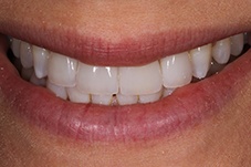 Closeup of Samantha after Long Island veneers