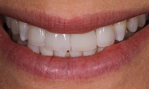 Close-up of smile after veneers have been used to close gap