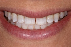 Closeup of Samantha before Long Island veneers