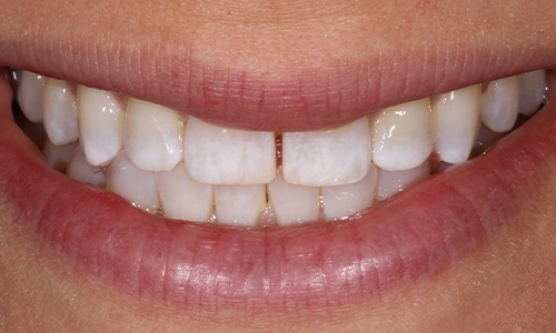 Close-up of smile with gap between front teeth