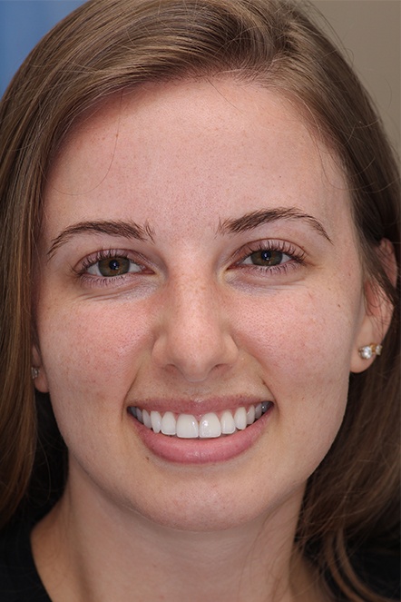 Headshot of female patient after veneers have been placed