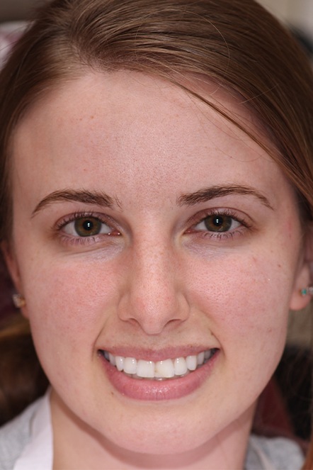 Headshot of female patient prior to dental work