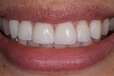 Closeup of Breanna after veneers