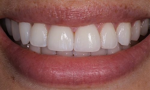Veneers used to improve appearance of smile