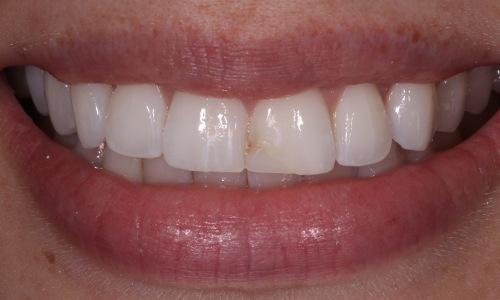 Slight discoloration between upper front teeth