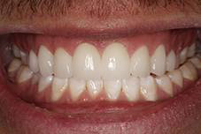 Closeup of Bobby's smile after treatment