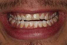 Closeup of Bobby's smile before treatment