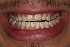 Closeup of Brendan's smiel before treatment