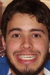Bobby's smile before treatment