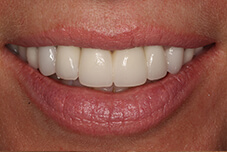 May 2017 closeup front of teeth after