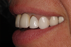 May 2017 closeup side of teeth before