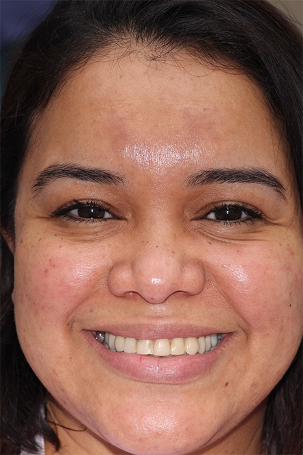 May 2022 patient showing yellowed teeth