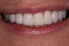 Closeup of Maureen after porcelain crowns and veneers
