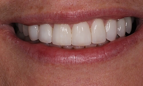 Close-up of smile brightened and straightened with veneers