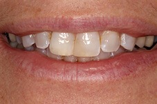 Closeup of Maureen before Long Island porcelain cornws and veneers