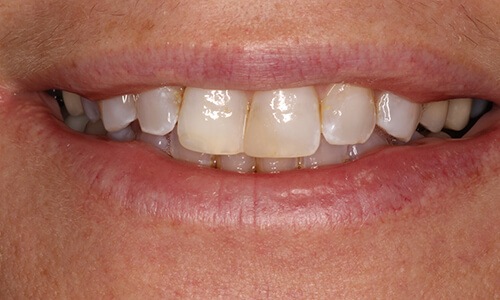 Close-up of smile with discoloration and misalignment