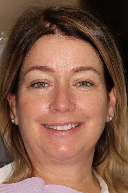 Headshot of woman with misaligned, discolored teeth