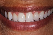 Closeup of Anabel after Long Island veneers