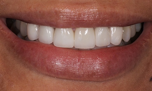 Close-up of smile brightened with veneers