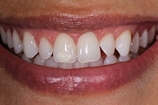 Closeup of Anabel before Long Island veneers