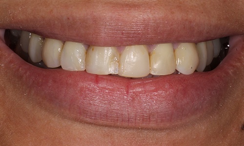 Close-up of smile with yellowed teeth
