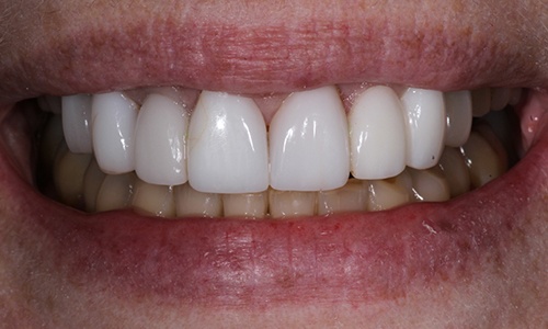 Close-up of Nancy's smile after treatment