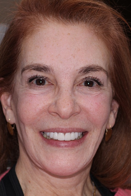Headshot of Nancy after dental work has been completed