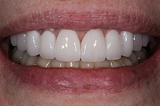 Closeup of Nancy before dental work