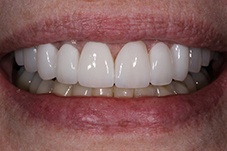 Closeup of Anabel before Long Island veneers