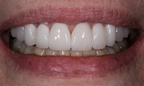 Close-up of Nancy's smile before treatment