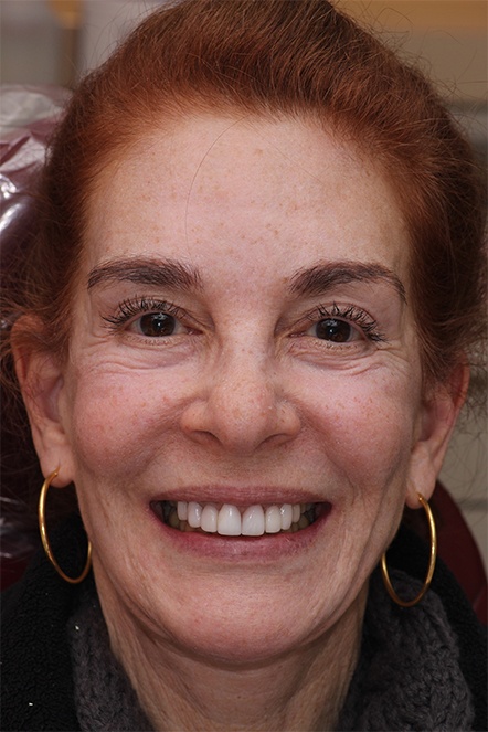 Headshot of Nancy before her dental work
