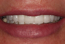 Closeup of Mary's smile after treatment
