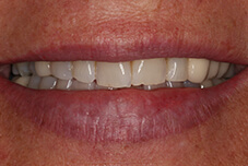 Closeup of Mary's Smile before treatment