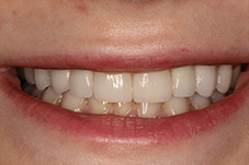 November 2017 dental implant patient front closeup after
