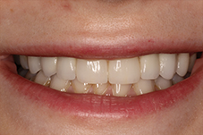 November 2017 front of smile after makeover