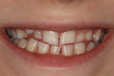 November 2017 dental implant patient front closeup before