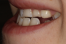 November 2017 dental implant patient side closeup before