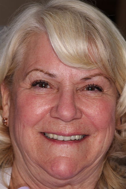 Woman with white hair showing smile before treatment