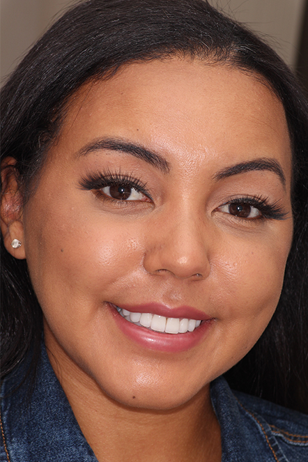 November 2021 patient with smile restored by dental crowns