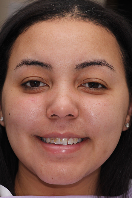November 2021 patient with damaged and discolored teeth
