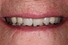 Closeup of Sherri before Long Island veneers dental treatment