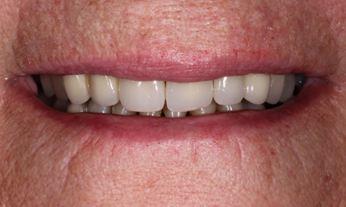 Close-up of front teeth looking dark and angled