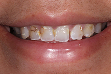Closeup of Crystal before Long Island veneers and porcelain crowns treatment