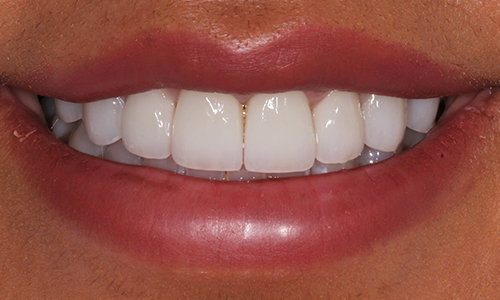 Close-up of teeth repaired with dental crowns