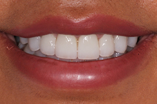 Closeup of Crystal after porcelain crowns and veneers